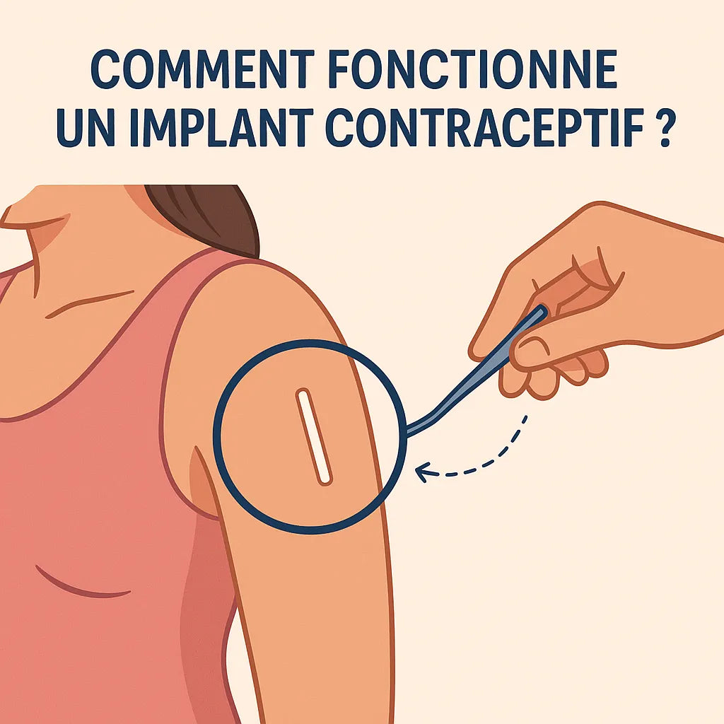 Comment Fonctionne Un Implant Contraceptif ?